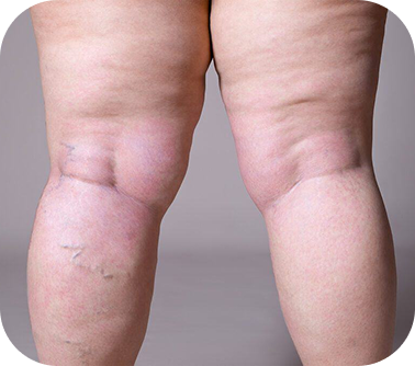 Lymphedema